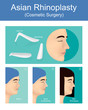 Rhinoplasty is a  plastic surgery creates a aesthetic and facially proportionate nose for correcting or other problems that affect breathing. Illustration vector.
