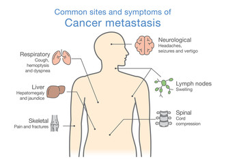 Most common sites and symptoms of Cancer Metastasis. Illustration about medical diagram of deadly diseases.