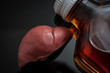 Alcoholic liver damage and cirrhosis concept with a liver next to a flask of alcohol. Cirrhosis is most commonly caused by alcoholism, hepatitis B or C or non-alcoholic fatty liver disease