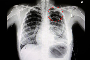 Chest x-ray film of patient with Pneumothorax