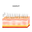 Dandruff on hair scalp. Disorders of the scalp