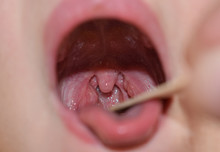 Angina Throat Examination