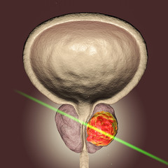 Conceptual image for prostate cancer laserotherapy, 3D illustration showing destruction of a tumor inside prostate gland with laser