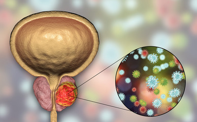 Poster - Conceptual image for viral ethiology of prostate cancer. 3D illustration showing viruses infecting prostate gland which develops cancerous tumor