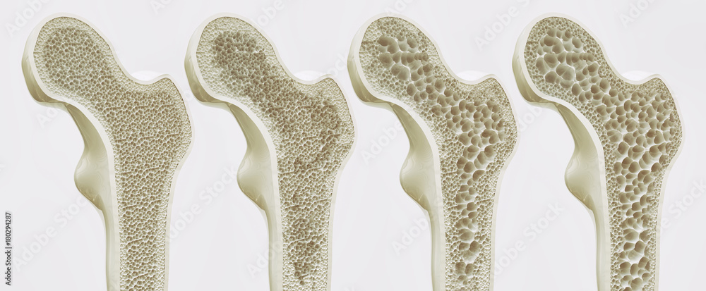 4 Stadien der Osteoporose - obrazy, fototapety, plakaty 