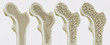 canvas print picture - 4 Stadien der Osteoporose