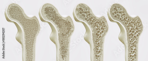 Fotografía 4 Stadien der Osteoporose