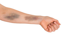 Large Bruise On Human Arm