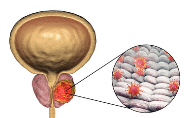 Poster - Conceptual image for viral ethiology of prostate cancer. 3D illustration showing viruses infecting prostate gland which develops cancerous tumor