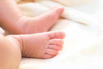 Closeup legs of newborn with peeling skin on white cloth, health care and medical concept, selective focus