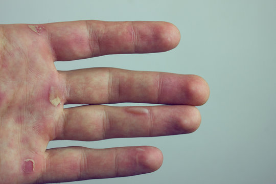 hands with blister and callus