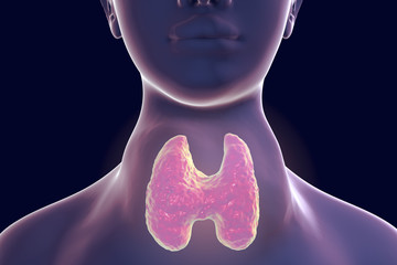 Poster - Toxic diffuse goiter, Flajani-Basedow-Graves' disease. 3D illustration showing enlarged thryoid gland in a female with hyperthyroidism