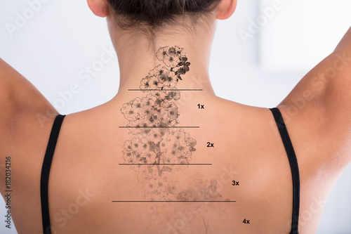 tattoo removal on woman u0027s back buy this stock photo and explore tattoo removal on woman u0027s back buy this stock photo and explore