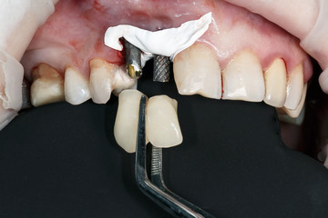 ceramic teeth and abutments