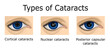 © scio21 - Types of Cataracts