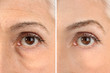Mature woman before and after biorevitalization procedure, closeup