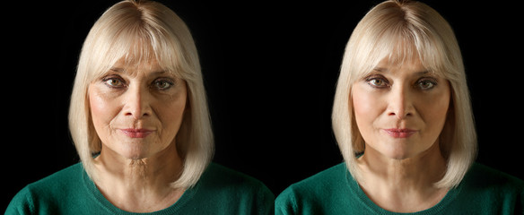 Sticker - Mature woman before and after biorevitalization procedure on black background