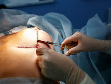 Operation Close Up. Breast Augmentation Surger