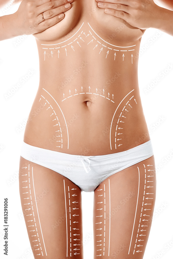 Female body with patterned lines and arrows on it, isolated on white. The concept of plastic surgery, fat removal, liposuction and cellulite. - obrazy, fototapety, plakaty 