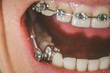 Braces and dental appliance for deep bite