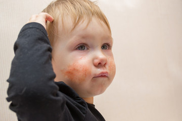 Cute child 1 - 2 years old with eczema or allergic rash on his face, crying in pain