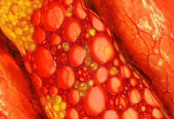 Cholesterol plaque in blood vessel