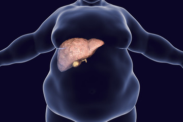 Poster - Obese man with fatty liver, 3D illustration. Conceptual image for non-alcoholic fatty liver disease