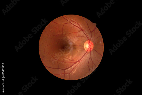 Fotografía Photo Madical Retina Abnormal isolated on black background