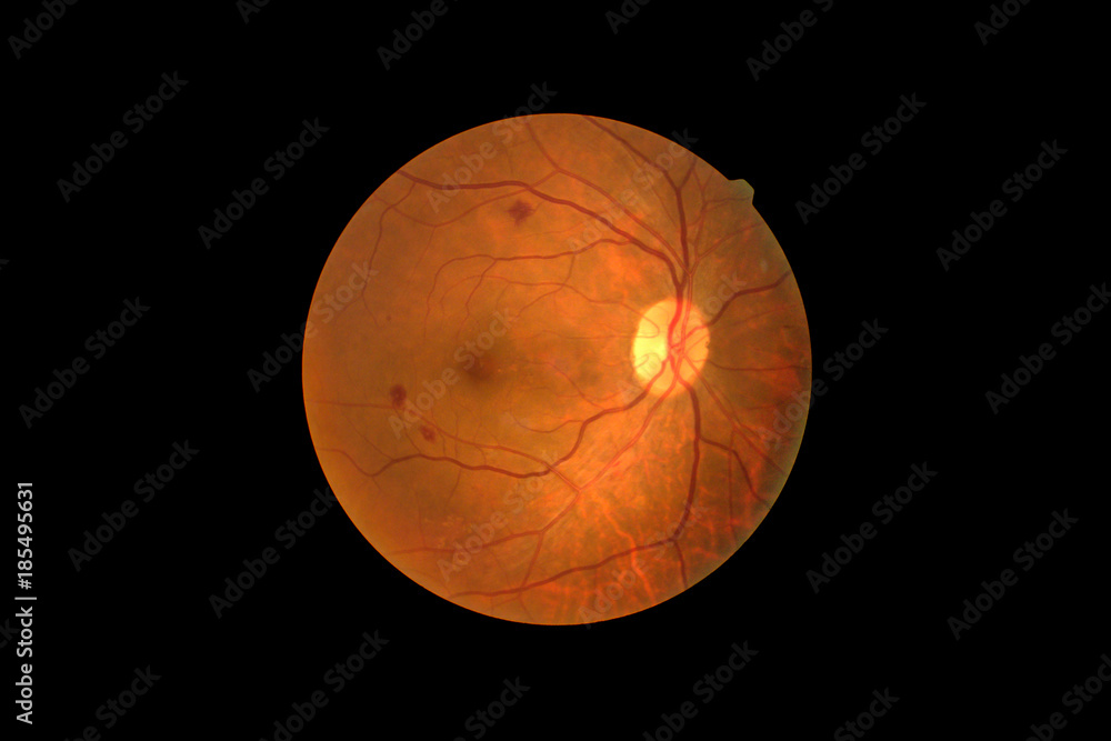 Photo Madical Retina Abnormal isolated on black background.Retina of diabetes   diabates retinopathy. - obrazy, fototapety, plakaty 