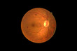 Photo Madical Retina Abnormal isolated on black background.Retina of diabetes   diabates retinopathy.