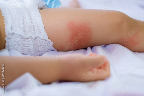Leg of sleeping Small child with redness on the skin