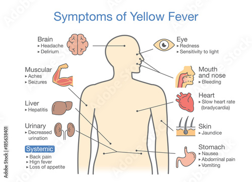 Fotografía Diagram of Symptoms of Yellow fever patient