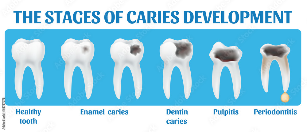 Pulp Caries The stages of caries development. 3d realistic vector illustration ...