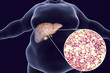 © Dr_Microbe - Obese man with fatty liver, 3D illustration and photomicrograph of liver steatosis. Conceptual image for non-alcoholic fatty liver disease