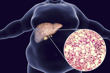Obese Man With Fatty Liver, 3D Illustration And Photomicrograph Of Liver Steatosis. Conceptual Image For Non-alcoholic Fatty Liver Disease