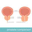 vector illustration of normal and enlarged prostate comparison