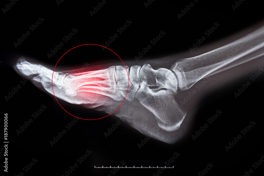 x-ray of foot on black background Stock Photo | Adobe Stock