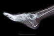© muratart - x-ray of foot on black background