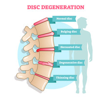 Disc Degeneration Flat Illustration Vector Diagram With Condition Exampes - Bulging, Hernoated, Degenerative And Thinning Disc. Educational Medical Information.
