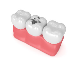 3d render of teeth with dental amalgam filling