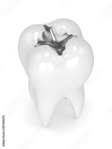 Fotografija 3d render of tooth with dental amalgam filling