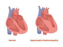 Normal Heart And Hypertrophic Heart. Hypertrophic Cardiomyopathy Vector Illustration