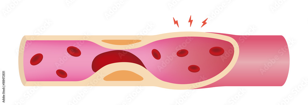 Artery clogged with Blood clot illustration Stock Vector | Adobe Stock