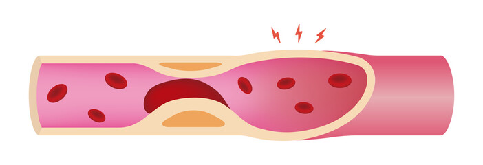 Artery clogged with Blood clot illustration