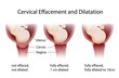 © Alila Medical Media - Cervical Effacement and Dilatation