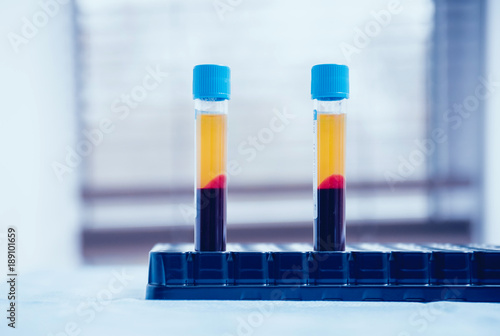 Fotografía Platelet-Rich plasma preparation. Plasma in syringe. Centrifuge.