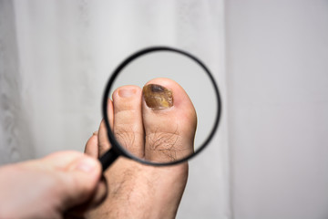 Wall Mural - under the magnifying glass, observing changes on a sick nail