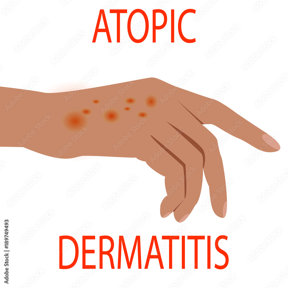 Atopic dermatitis health, medical, skin, pain, dermatitis, eczema ...
