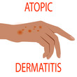 Atopic dermatitis health,  medical,  skin,  pain,  dermatitis,  eczema,