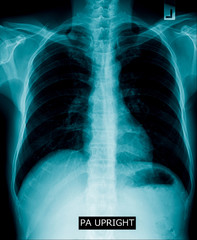 Canvas Print - Chest x-ray in blue tone